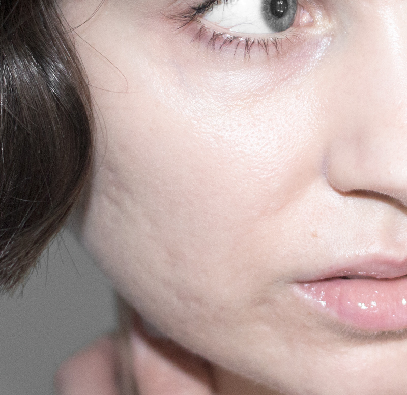 urine foams on accutane and